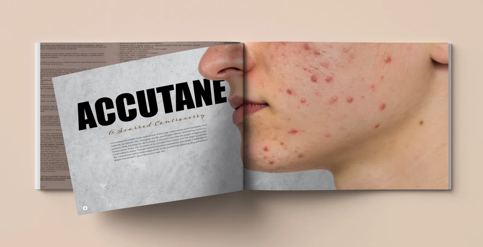 Accutane: A Scarred Controversy — image 3